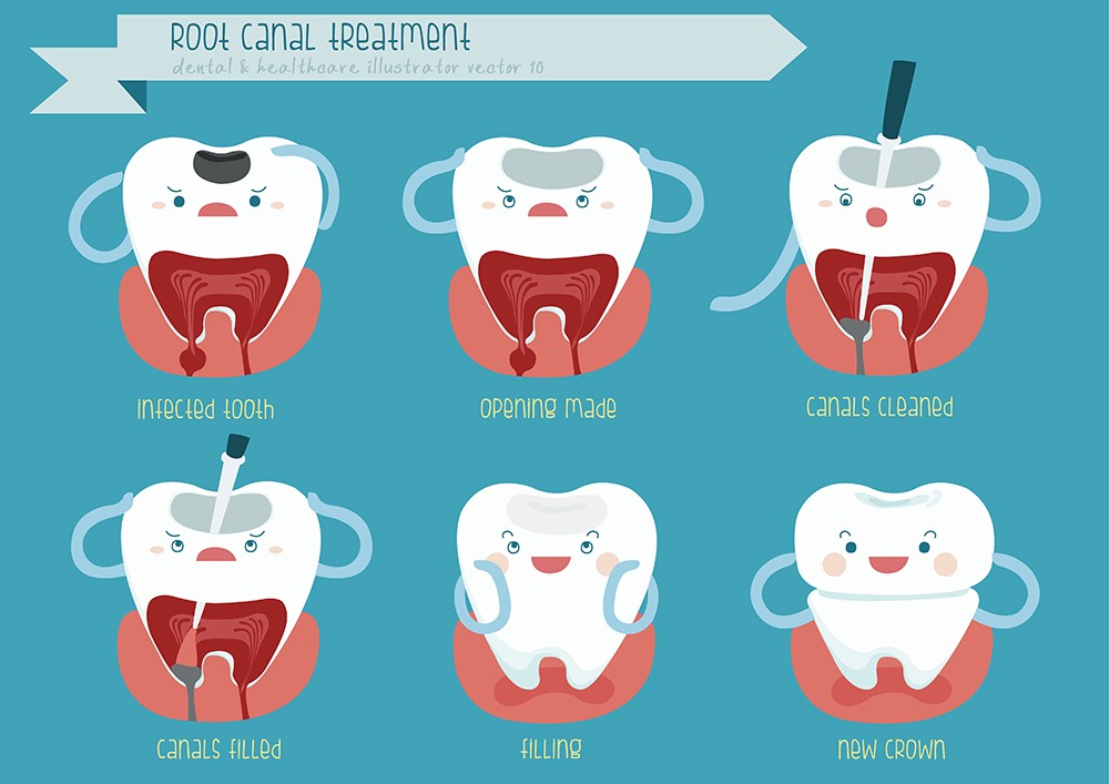 Root canal treatment - Lavaca dental