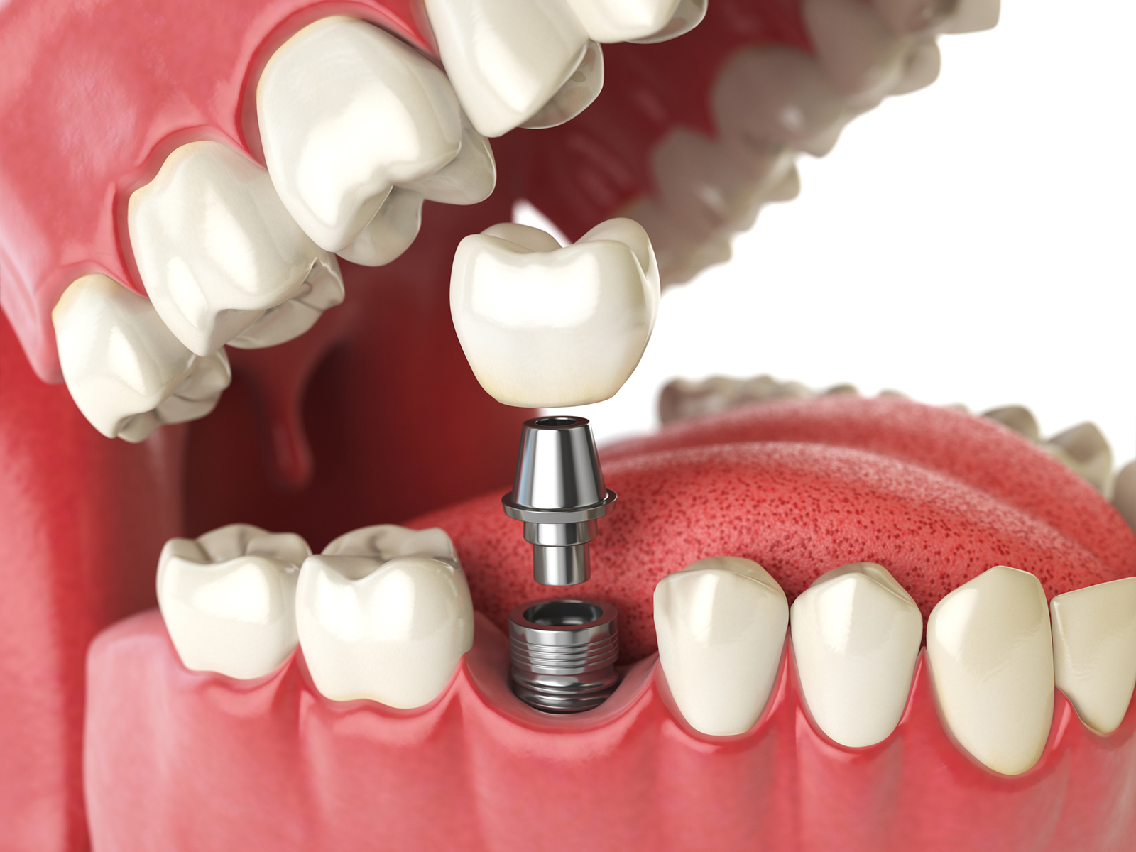 How are dental implants secured?
