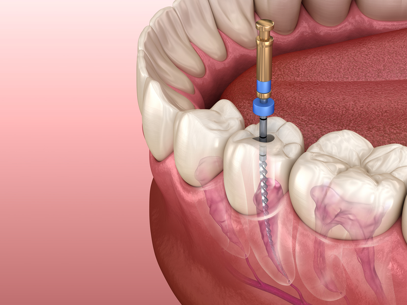 What should I avoid after a root canal?