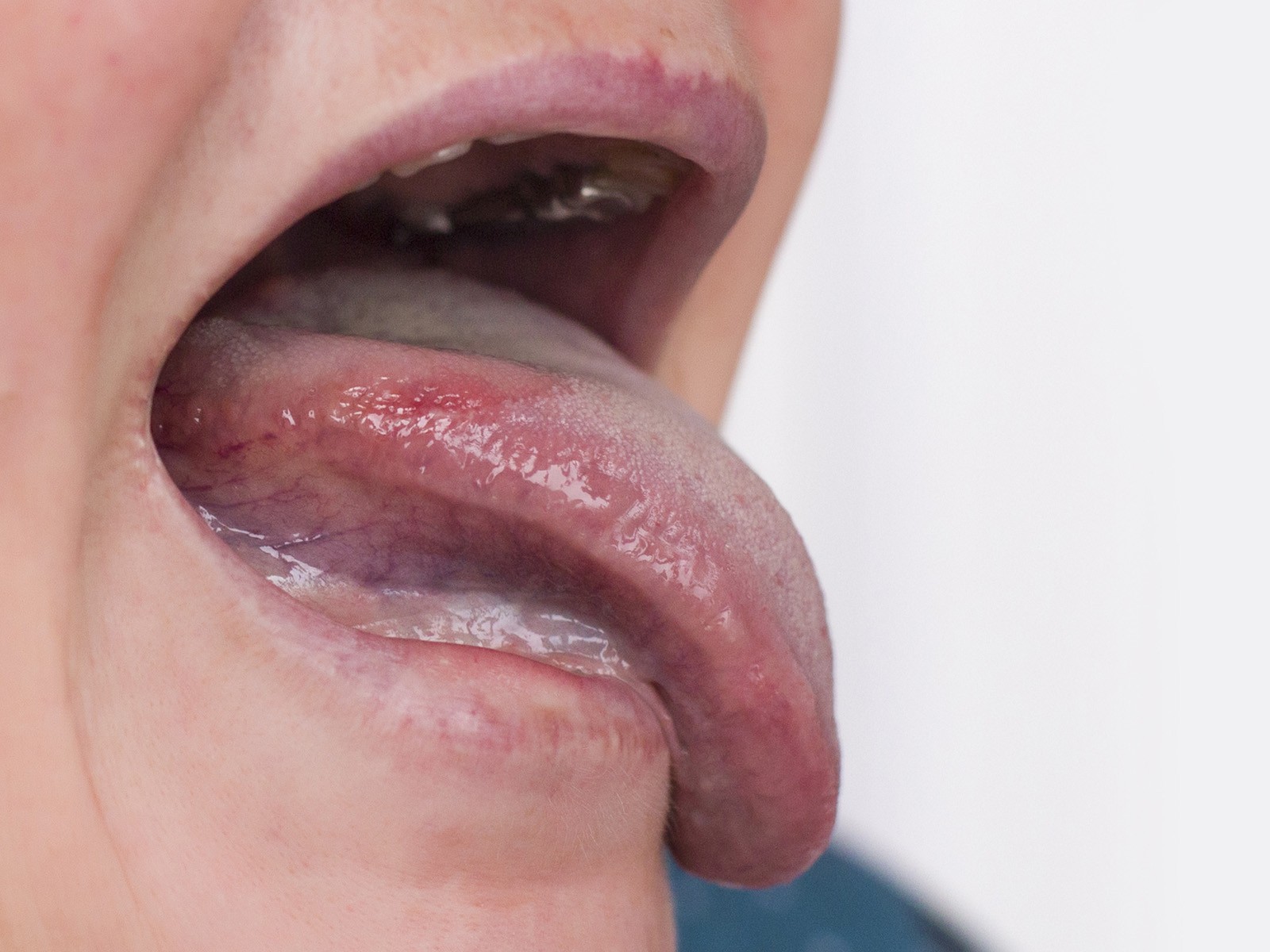 What is Leukoplakia?