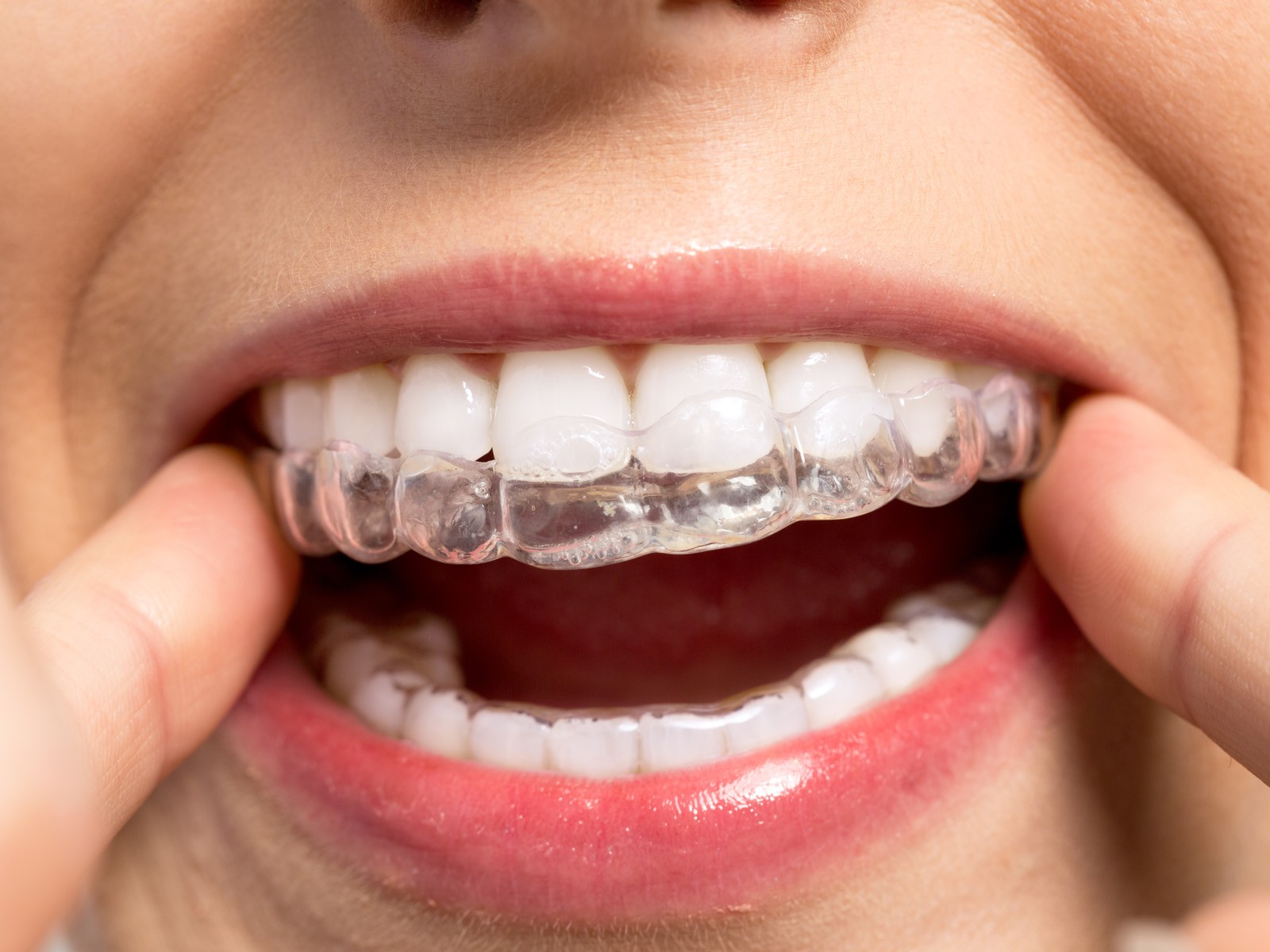 How long do 40 Invisalign trays take?