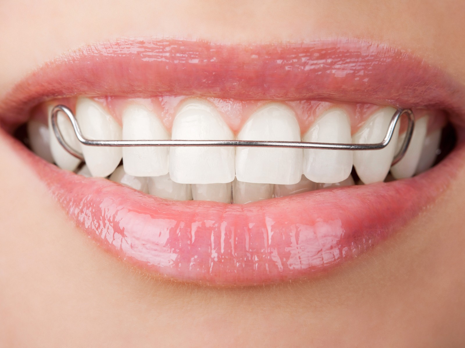 Are retainers good for your teeth?