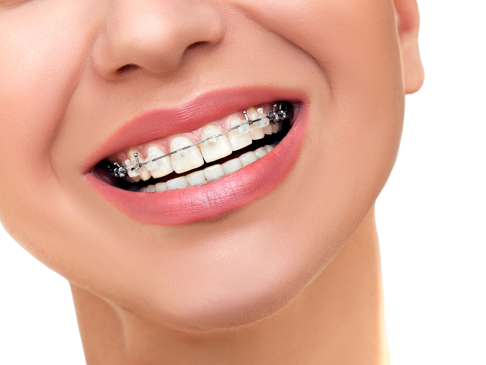 Advantages and Disadvantages of Ceramic Braces