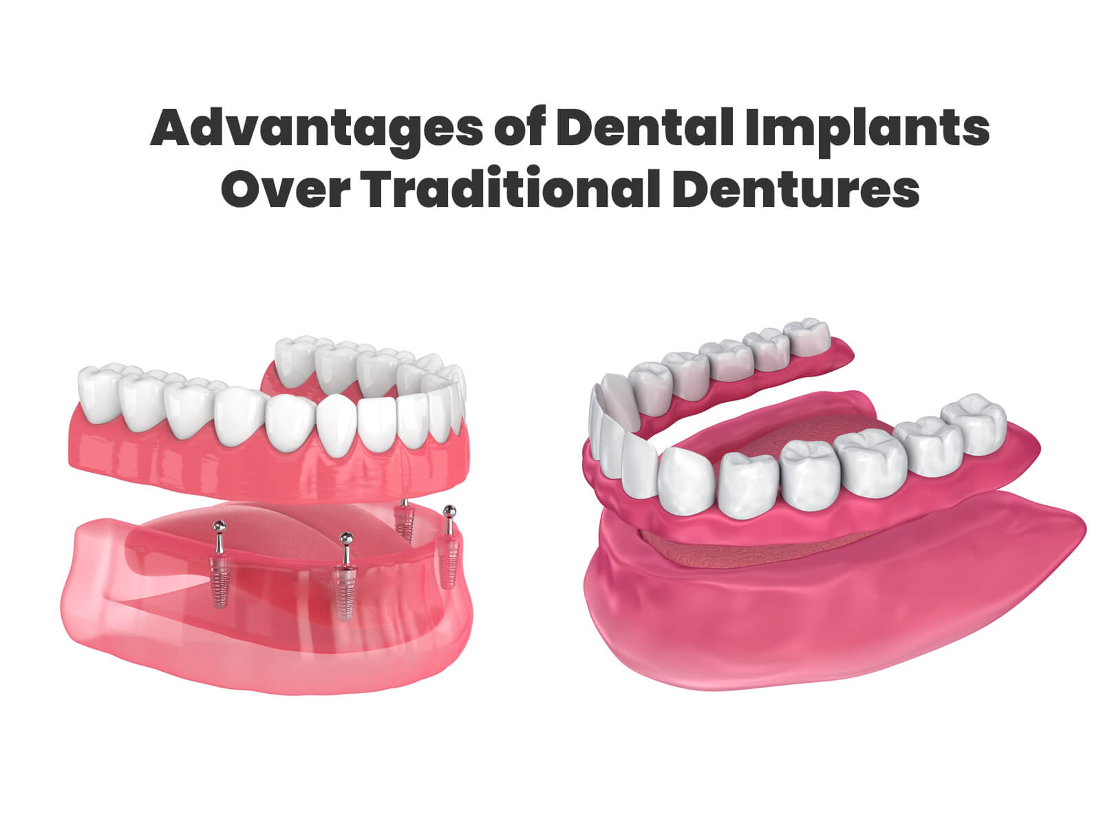 Advantages of Dental Implants Over Traditional Dentures