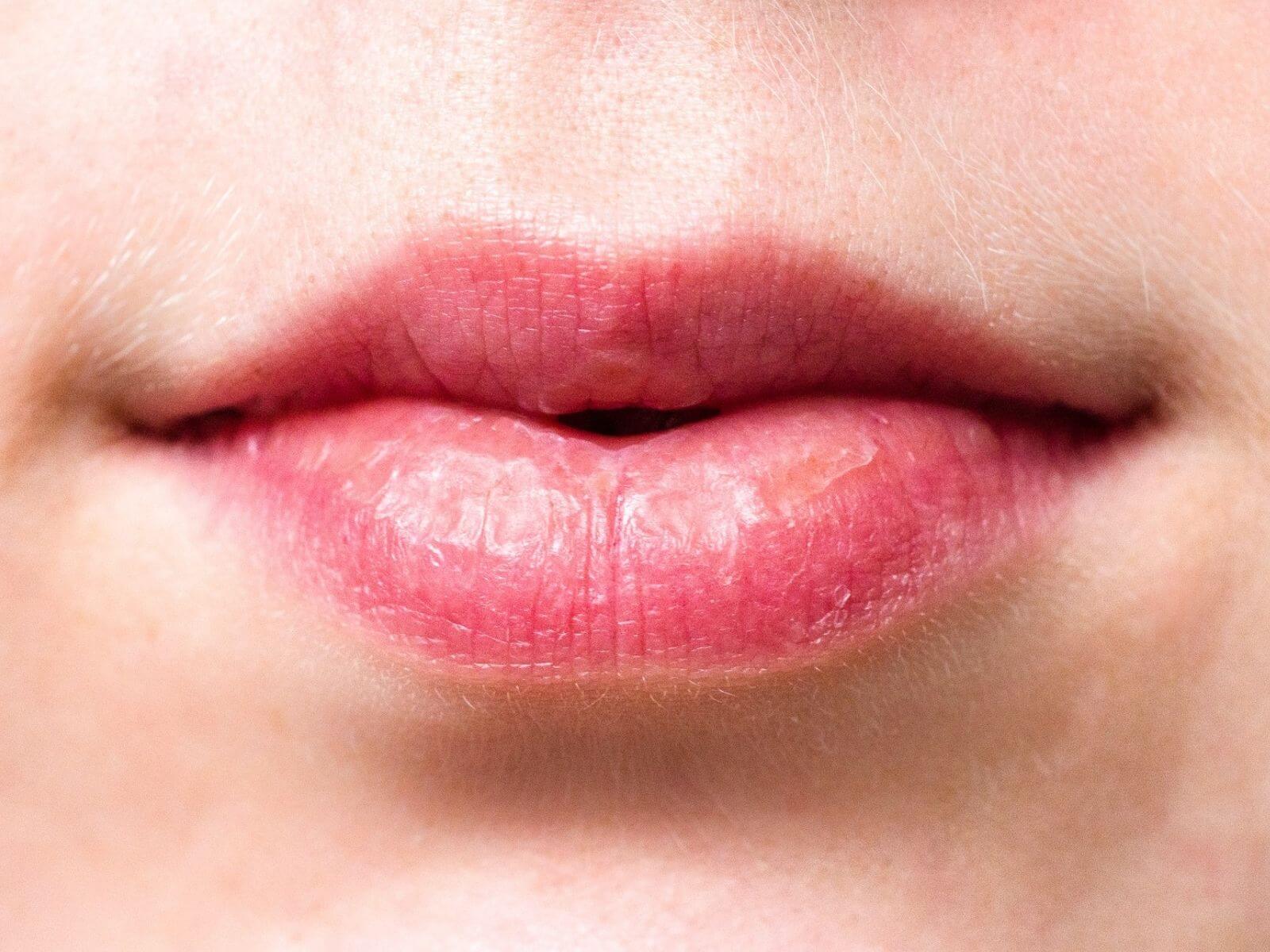 Dry Mouth: Effective Tips And Tricks To Alleviate It