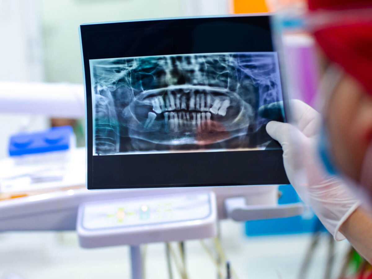 How Dental Implants Help With TMJ Treatment