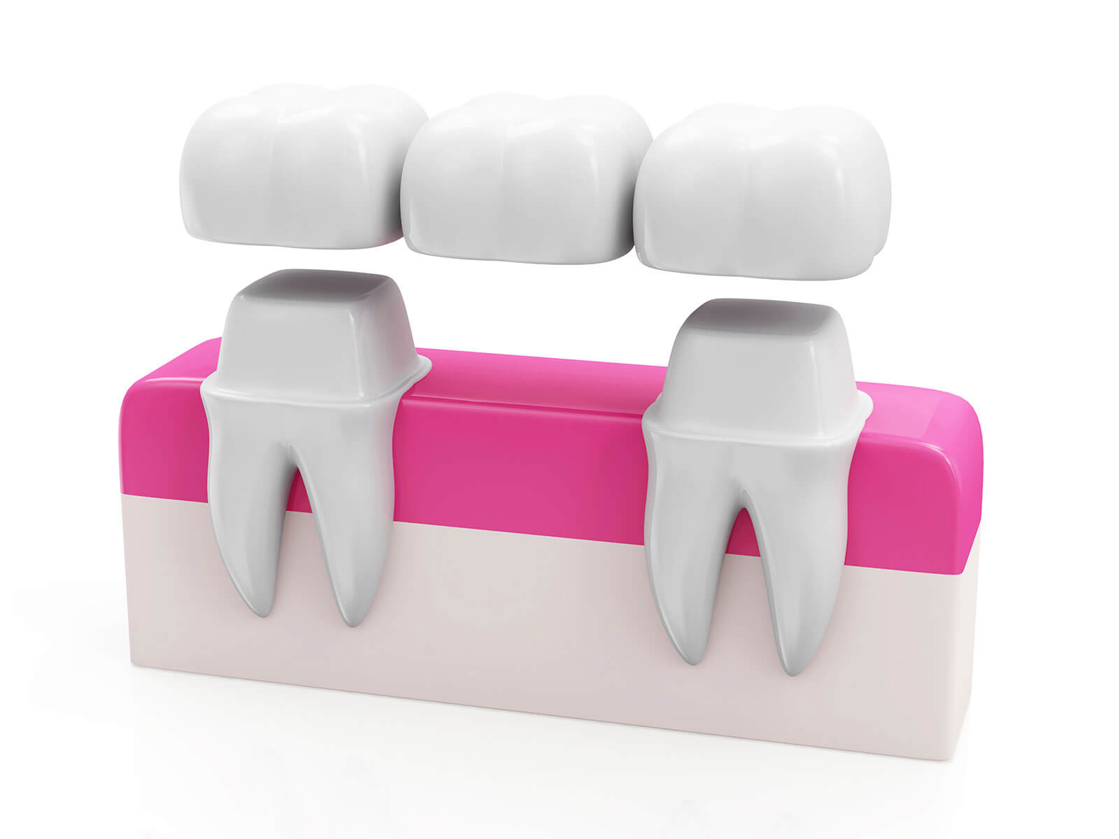 How to Clean and Care for a Dental Bridge