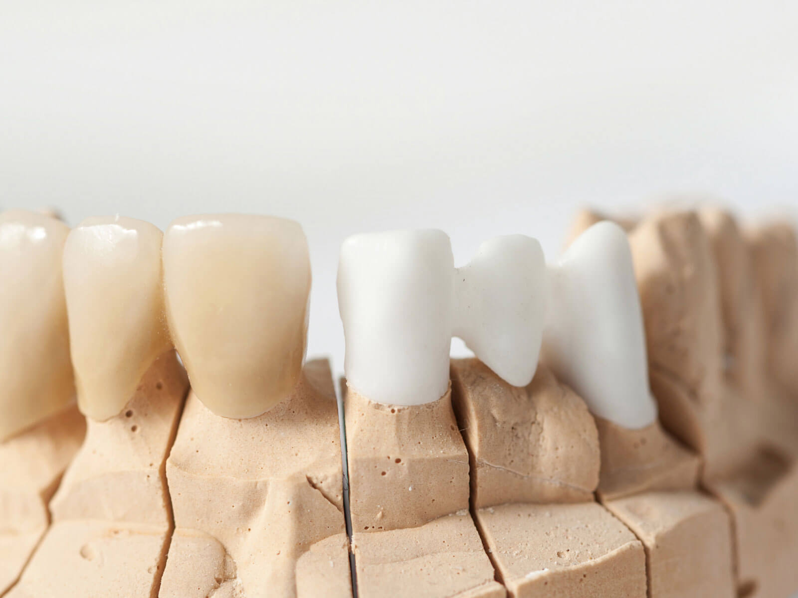 Dental Implants vs Bridges: Key Differences Explained