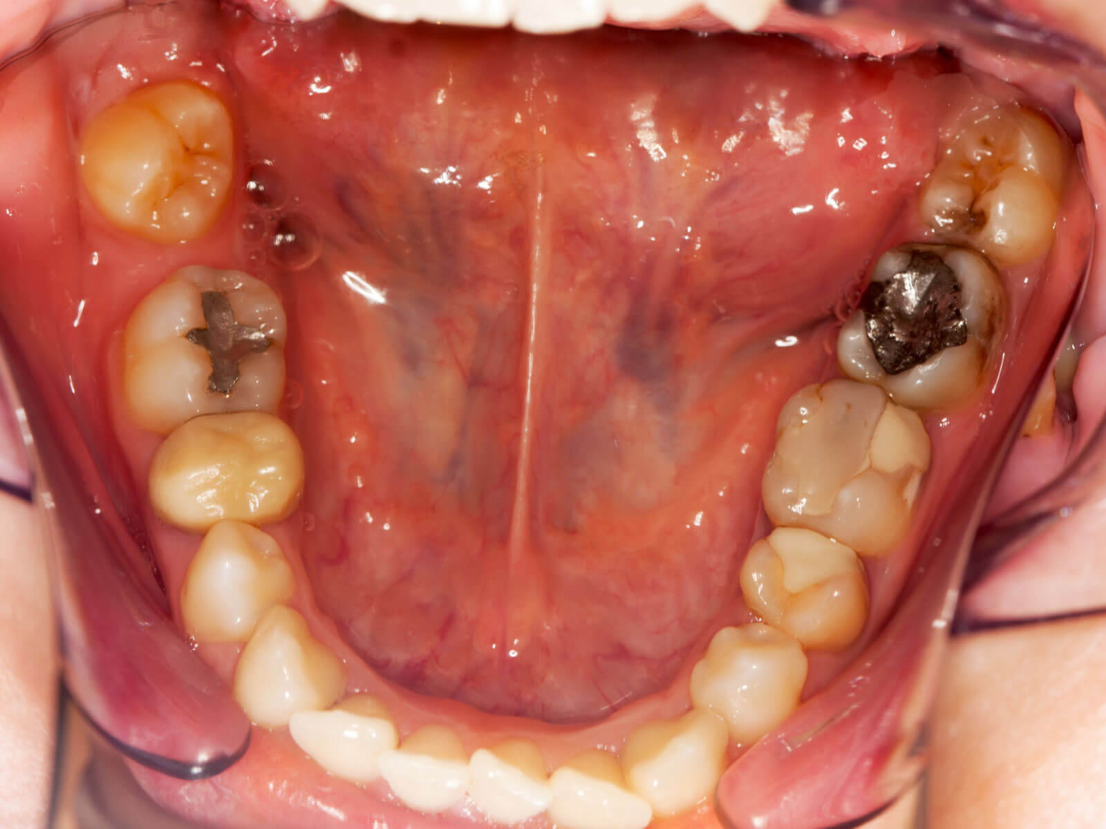 Does Getting a Tooth Filling Hurt?