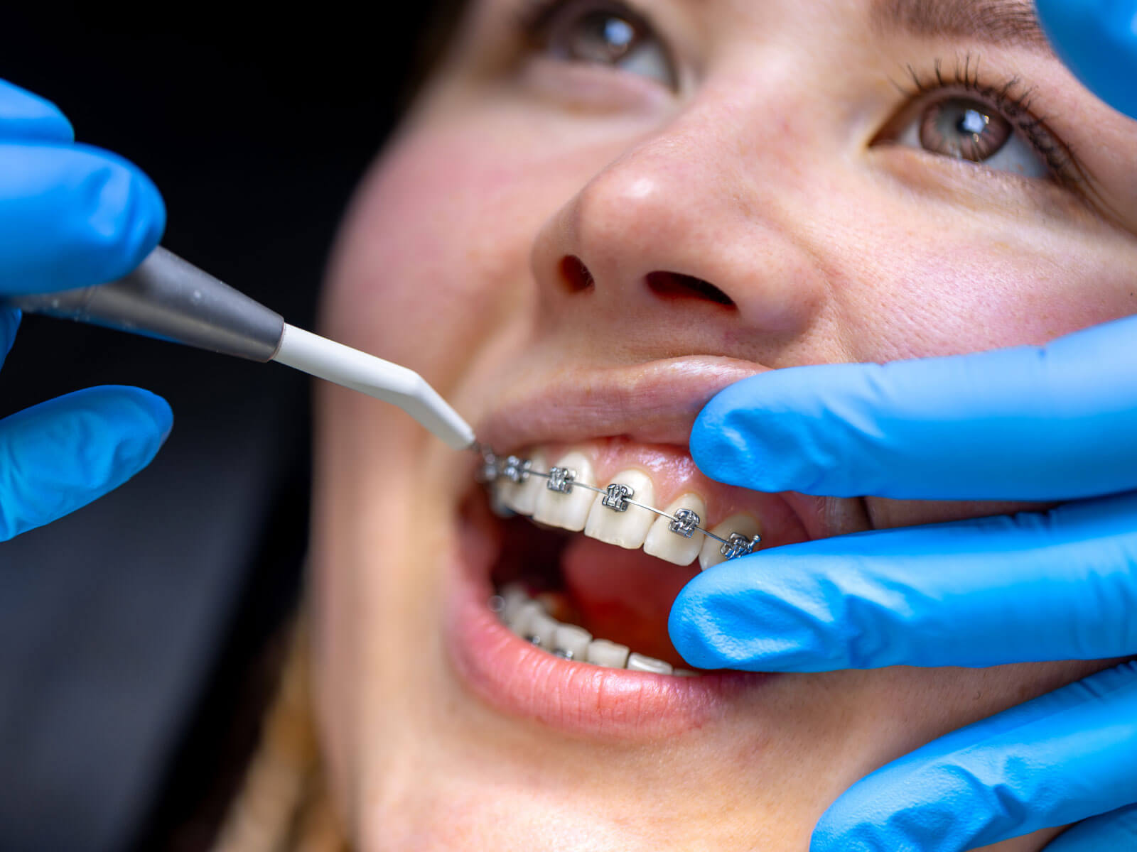 How Much Do Braces Cost in 2026? Average Price by Type