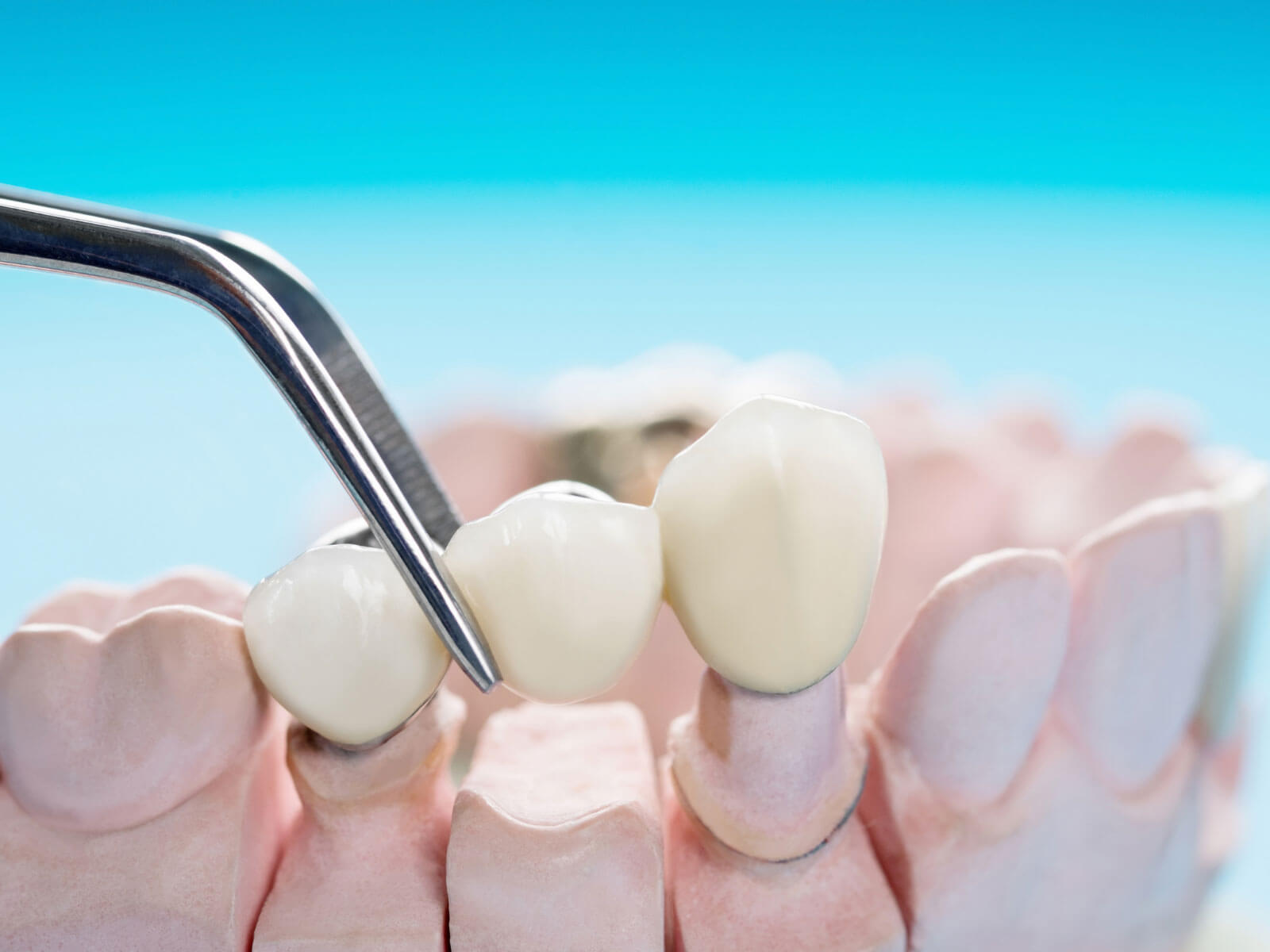 Comparing the Types of Dental Crowns: Materials, Cost & Durability